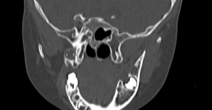 Choanal atresia (Radiopaedia 51295-56972 Coronal bone window 80).jpg