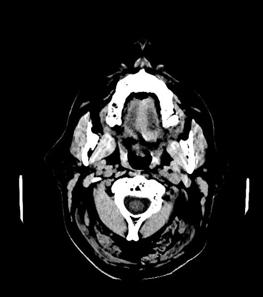 File:Cholangiocarcinoma with cerebral metastases (Radiopaedia 83519-98628 Axial non-contrast 1).jpg