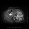 Choledochal cyst with chronic calcific pancreatitis (Radiopaedia 18245-18062 Axial T2 5).png