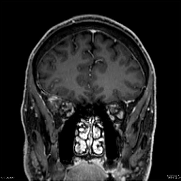 File:Chondrosarcoma of skull base- grade II (Radiopaedia 40948-43654 Coronal T1 C+ 52).jpg