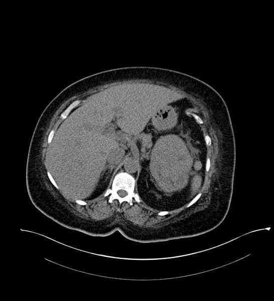 File:Chromophobe renal cell carcinoma (Radiopaedia 84239-99519 Axial non-contrast 53).jpg
