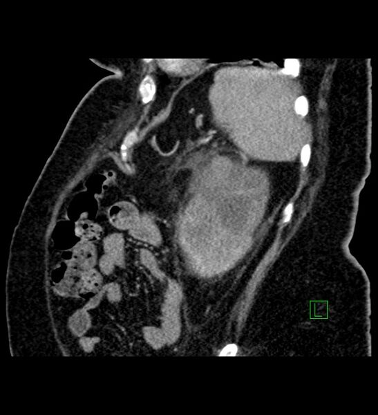 File:Chromophobe renal cell carcinoma (Radiopaedia 84239-99519 D 26).jpg