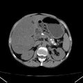 Chronic pancreatitis (Radiopaedia 23132-23172 Axial non-contrast 27).jpg
