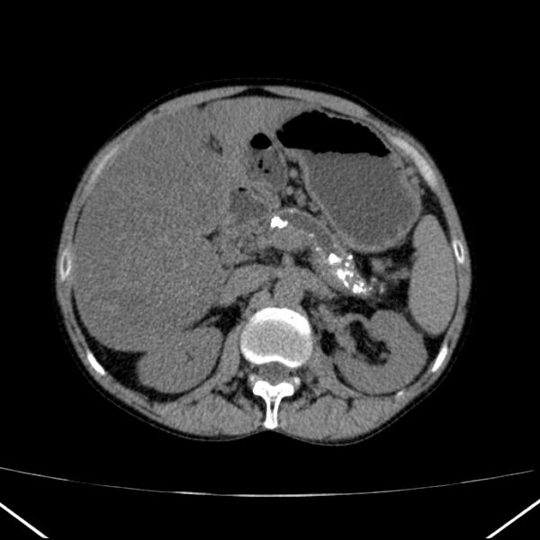 File:Chronic pancreatitis (Radiopaedia 23132-23172 Axial non-contrast 27).jpg