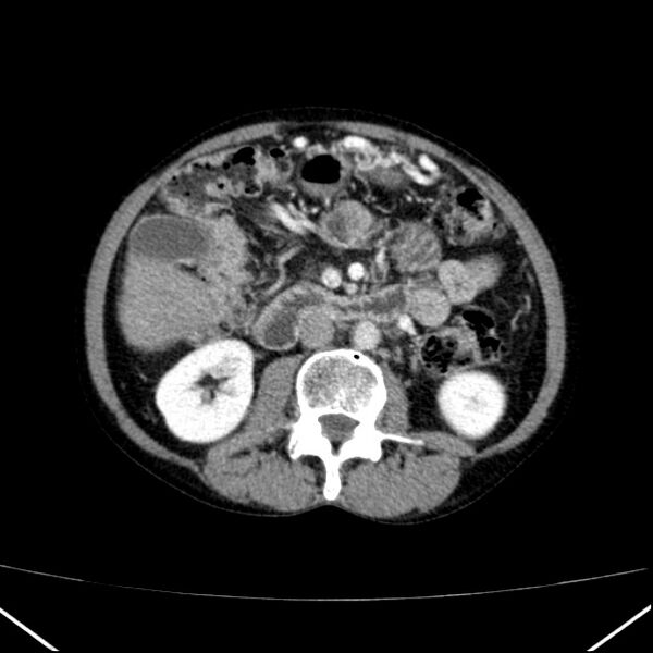 File:Chronic pancreatitis (Radiopaedia 23132-23172 B 29).jpg
