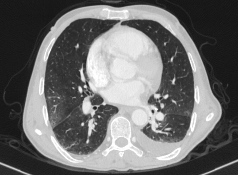 File:Chronic pulmonary embolism with bubbly consolidation (Radiopaedia 91248-108850 Axial lung window 92).jpg