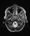 Chronic reactive multifocal osteomyelitis (CRMO) - mandible (Radiopaedia 56405-63069 Axial T2 19).jpg