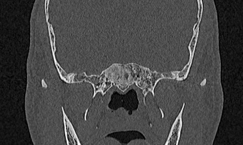 File:Chronic rhinosinusitis (Radiopaedia 65079-74075 Coronal bone window 75).jpg
