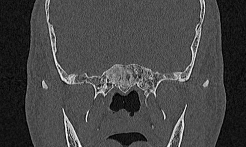 Chronic rhinosinusitis (Radiopaedia 65079-74075 Coronal bone window 75).jpg
