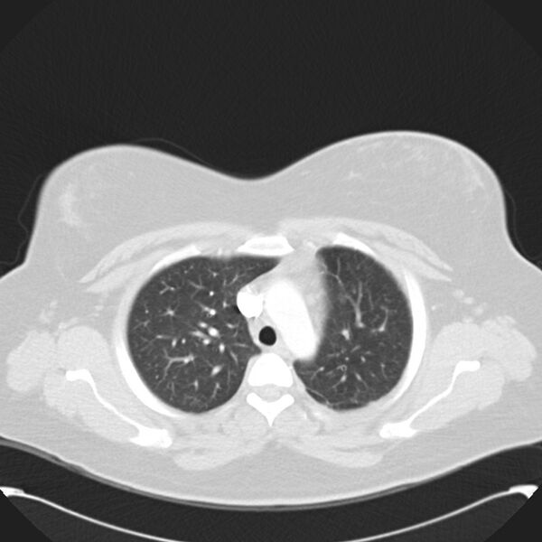 File:Chronic thromboembolic pulmonary hypertension (CTEPH) (Radiopaedia 74597-85531 Axial lung window 15).jpg