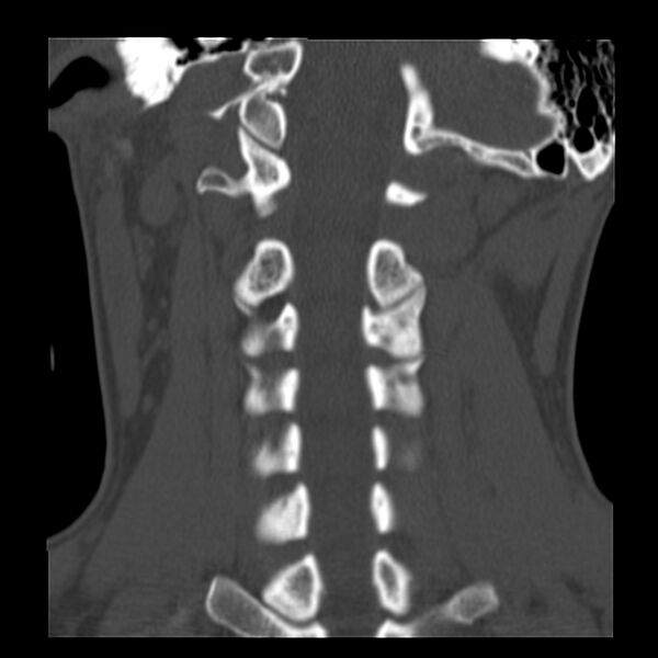 File:Clay-shoveler fracture (Radiopaedia 22568-22590 Coronal bone window 21).jpg