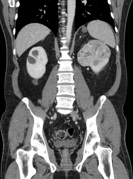 File:Clear cell renal cell carcinoma (Radiopaedia 61449-69393 F 32).jpg