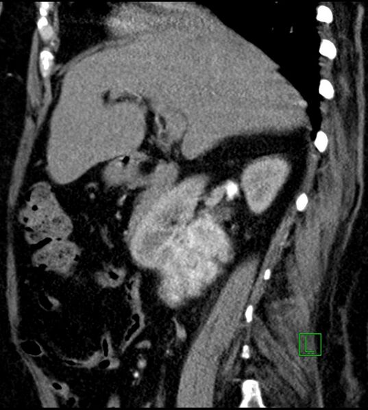 File:Clear cell renal cell carcinoma (Radiopaedia 85004-100537 D 40).jpg