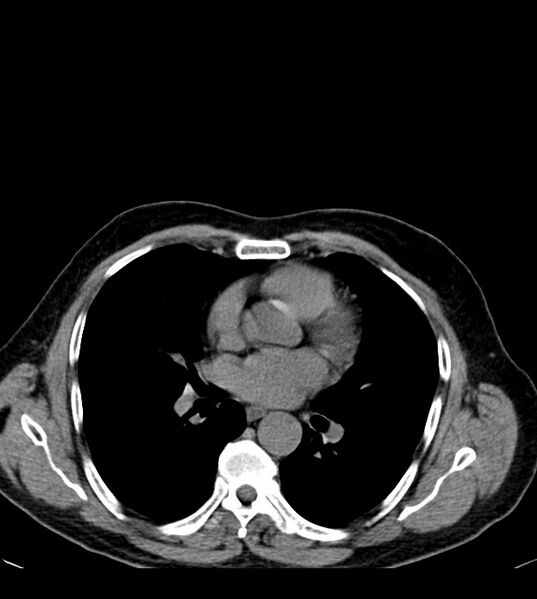 File:Clear cell renal cell carcinoma (Radiopaedia 85006-100539 Axial non-contrast 1).jpg