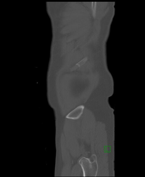 File:Clear cell renal cell carcinoma (Radiopaedia 85006-100539 Sagittal bone window 3).jpg