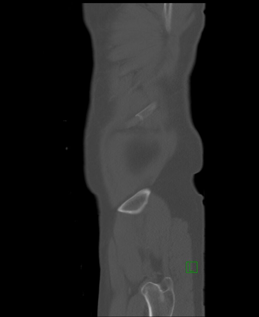 Clear cell renal cell carcinoma (Radiopaedia 85006-100539 Sagittal bone window 3).jpg
