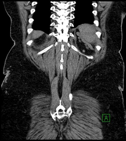 File:Closed-loop small bowel obstruction-internal hernia (Radiopaedia 78439-91096 Coronal non-contrast 87).jpg