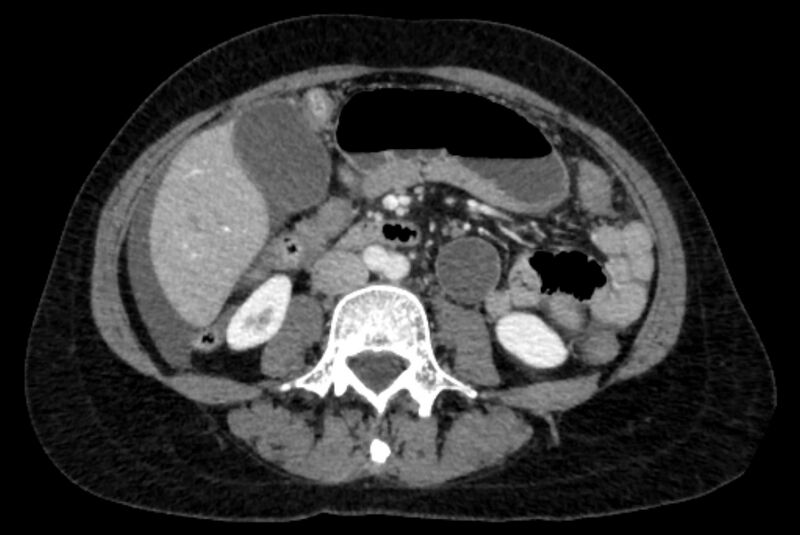 File:Closed loop small bowel obstruction (Radiopaedia 71211-81508 A 62).jpg