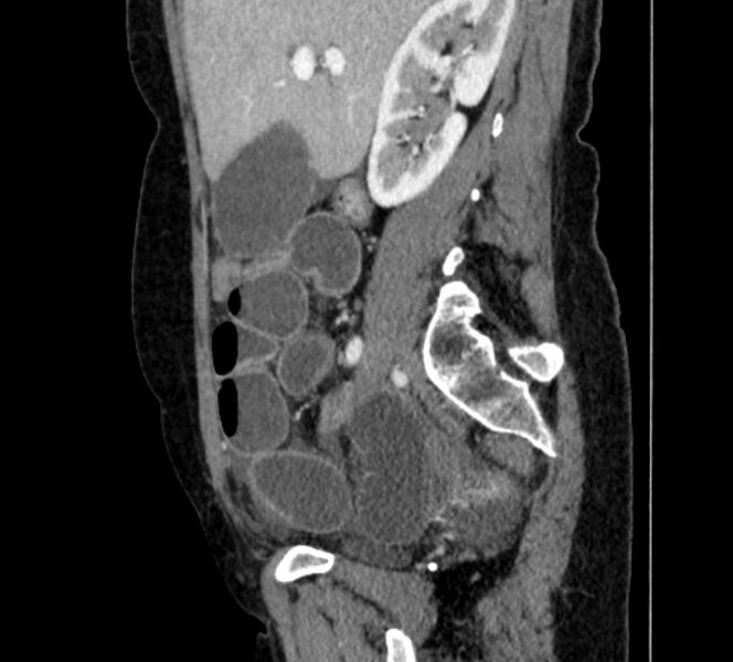 File:Closed loop small bowel obstruction (Radiopaedia 71211-81508 C 42).jpg