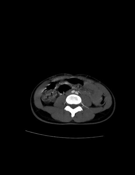 File:Coarctation of the aorta (Radiopaedia 27458-27657 D 36).jpg