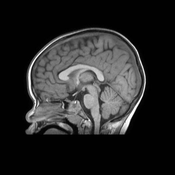 File:Cochlear nerve aplasia - unilateral (Radiopaedia 87910-104413 Sagittal T1 25).jpg