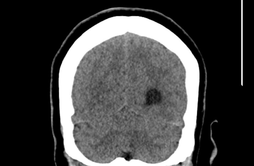 Colloid cyst (Radiopaedia 53180-59146 Coronal non-contrast 68).jpg