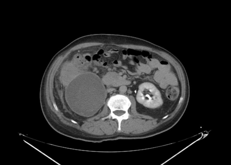 File:Colon cancer mimicking renal cell carcinoma (Radiopaedia 28986-29335 Axial C+ delayed 34).jpg