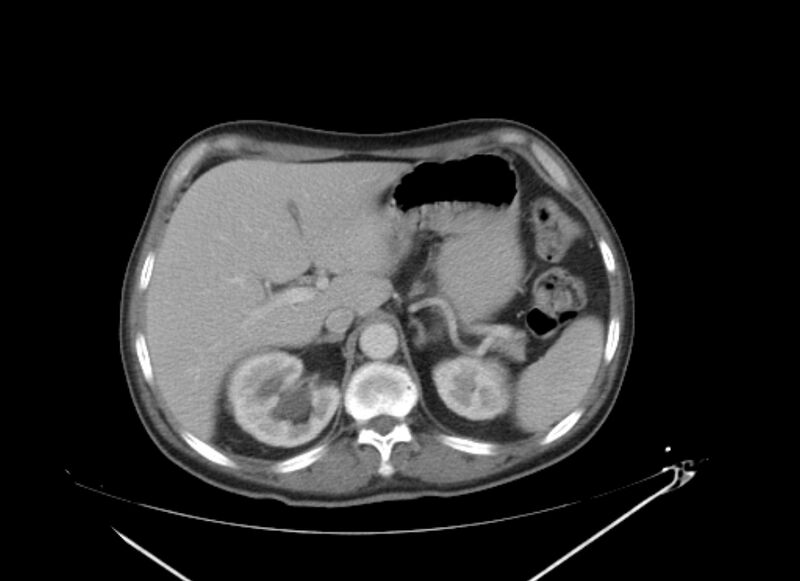 File:Colon cancer mimicking renal cell carcinoma (Radiopaedia 28986-29335 C 18).jpg