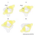 Fielding and Hawkins classification of atlantoaxial rotatory subluxation (Radiopaedia 42320).jpg