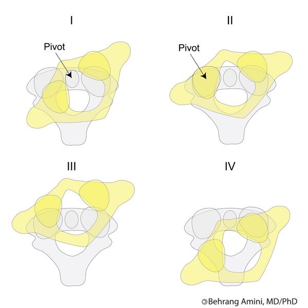 File:Fielding and Hawkins classification of atlantoaxial rotatory subluxation (Radiopaedia 42320).jpg