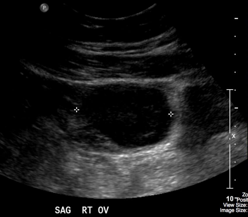Figure 11.2B Sagittal ultrasound of a right ovarian cyst.jpg