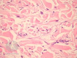 pathology-Papular mucinosis