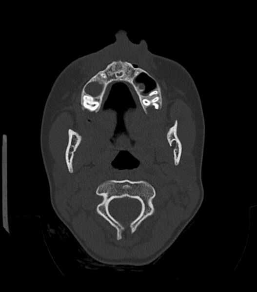 File:Nasoorbitoethmoid fracture (Radiopaedia 90044-107205 Axial bone window 48).jpg