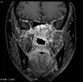 Nasopharyngeal carcinoma (Radiopaedia 4546-6667 E 3).jpg