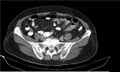 Necrotizing pancreatitis (Radiopaedia 20595-20495 Axial C+ delayed 34).jpg