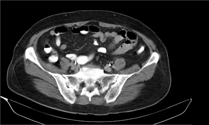 File:Necrotizing pancreatitis (Radiopaedia 20595-20495 Axial C+ delayed 34).jpg