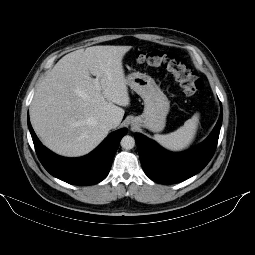 Neuroendocrine tumor of head of pancreas (Radiopaedia 57538-64502 D 17).jpg