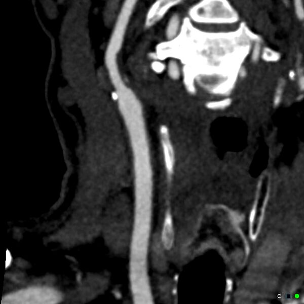 File:Non-occlusive intraluminal internal carotid artery thrombus (Radiopaedia 37751-39658 C 35).jpg