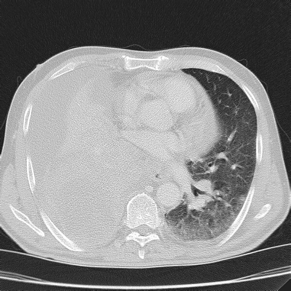 File:Non small-cell lung cancer (Radiopaedia 24467-24769 lung window 28).jpg