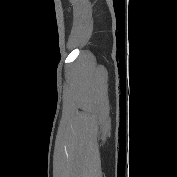 File:Normal CT angiogram of pelvis (Radiopaedia 45390-49430 C 7).jpg