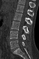 Normal CT lumbar spine (Radiopaedia 53981-60118 Sagittal bone window 49).jpg