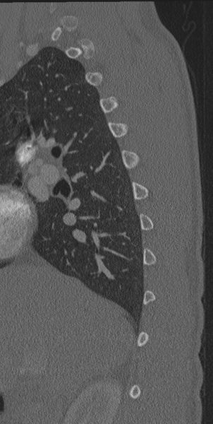 File:Normal CT thoracic spine (Radiopaedia 40181-42688 Sagittal bone window 57).png