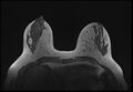 Normal breast MRI - dense breasts (Radiopaedia 80454-93850 Axial T1 81).jpg