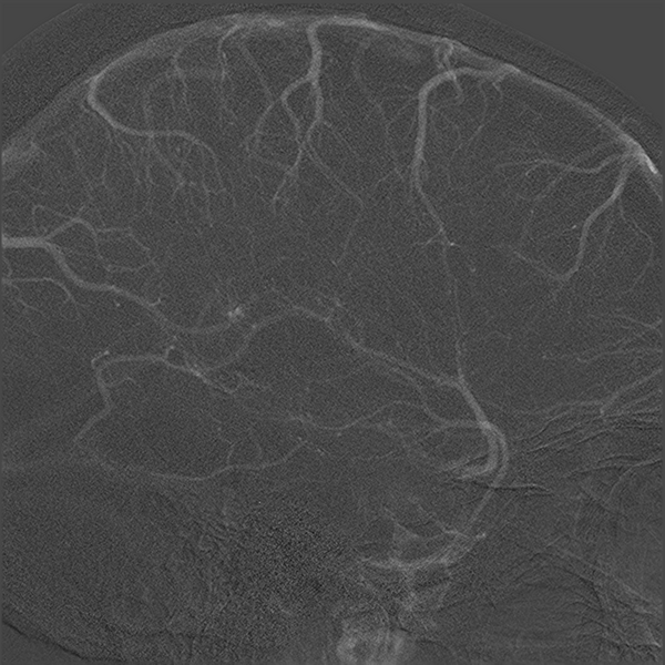 File:Normal cerebral angiogram (four vessel DSA) (Radiopaedia 41708-44649 F 17).png