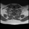 Normal cervical and thoracic spine MRI (Radiopaedia 35630-37156 Axial T1 9).png