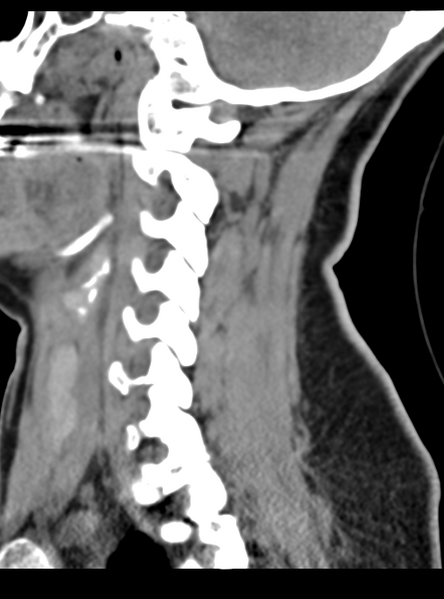 File:Normal cervical spine MRI (including Dixon) (Radiopaedia 42762-45926 C 42).png