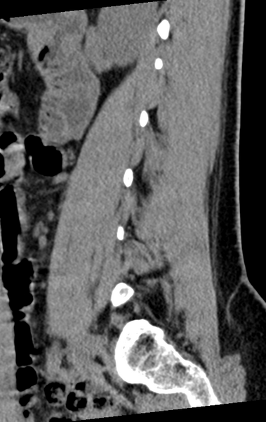 File:Normal lumbar spine CT (Radiopaedia 46533-50986 C 75).png