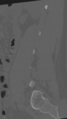 Normal lumbar spine CT (Radiopaedia 46533-50986 Sagittal bone window 26).png