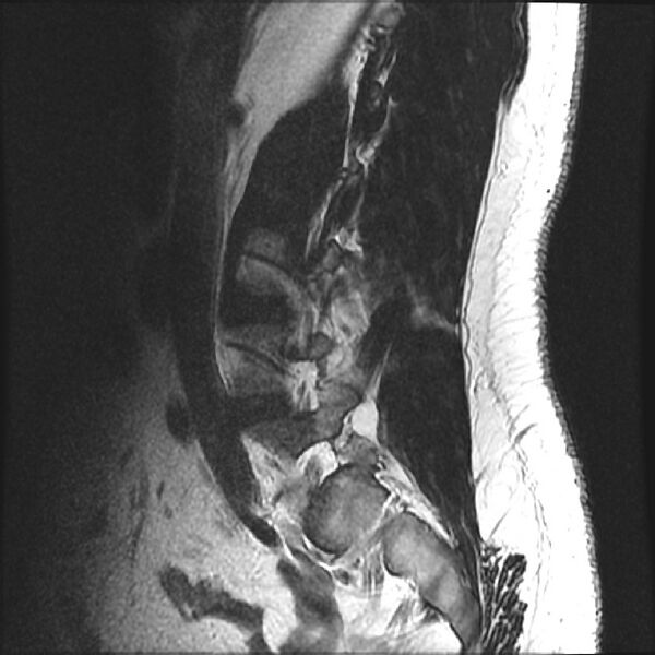 File:Normal lumbar spine MRI (Radiopaedia 43051-46311 Sagittal T2 17).jpg