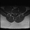 Normal lumbar spine MRI (Radiopaedia 47857-52609 Axial T1 24).jpg
